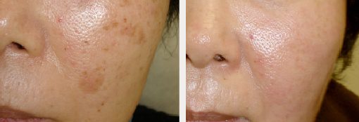 Brown Spot Treatments With Laser Dermatology Technology