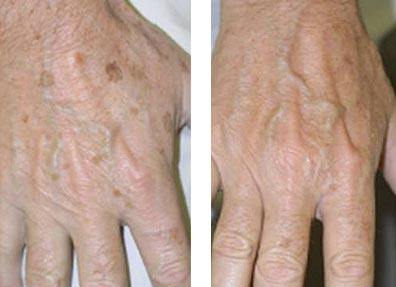 Brown Spot Treatments With Laser Dermatology Technology