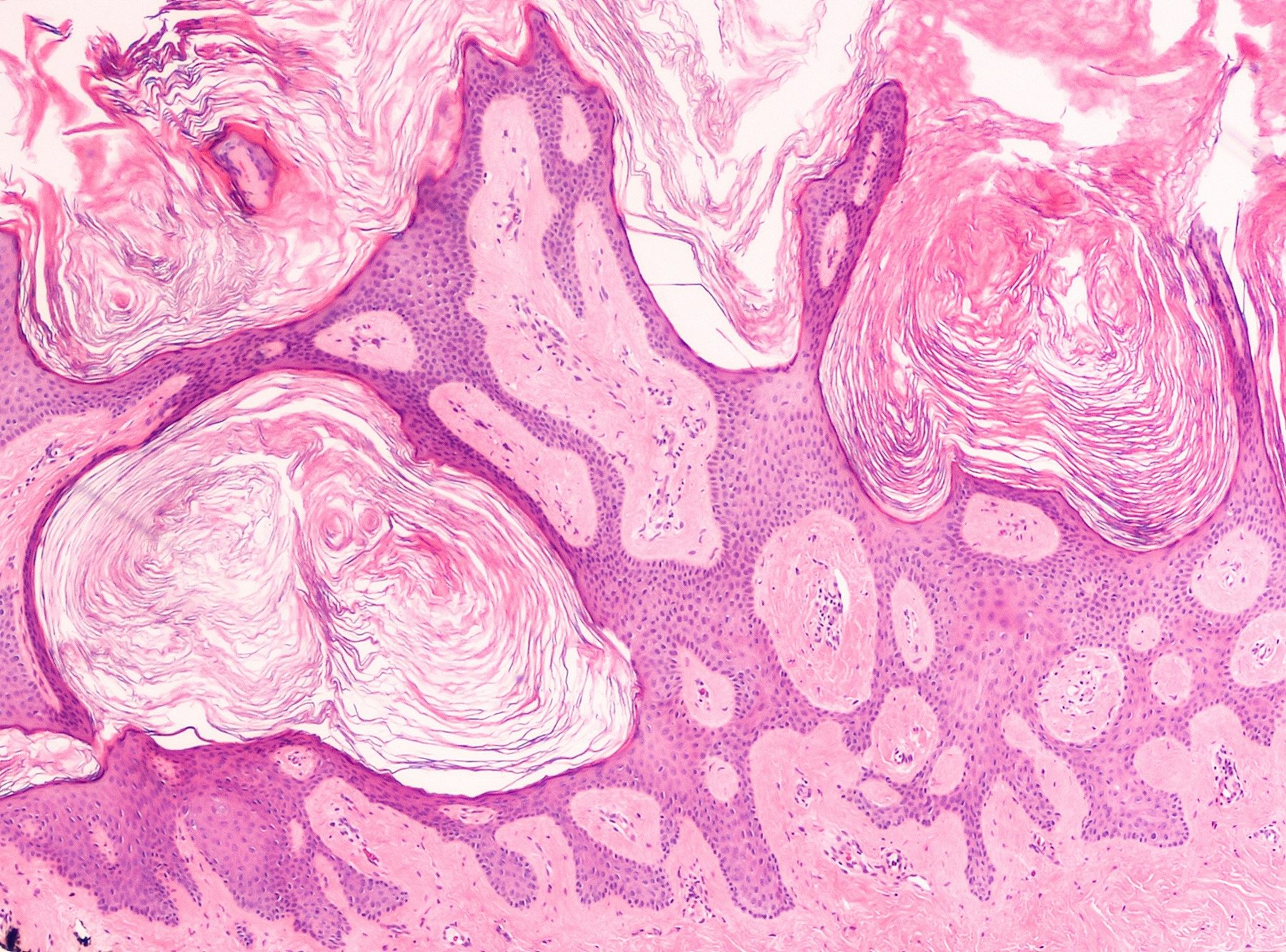 seborrheic keratosis histology