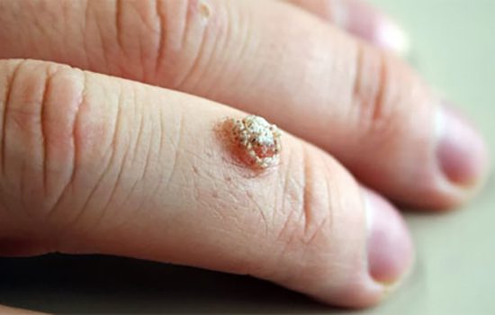 A wart on a finger.