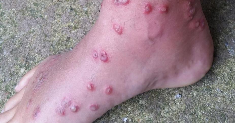 Sea Lice: That Nasty Rash You Get After Swimming In The Ocean