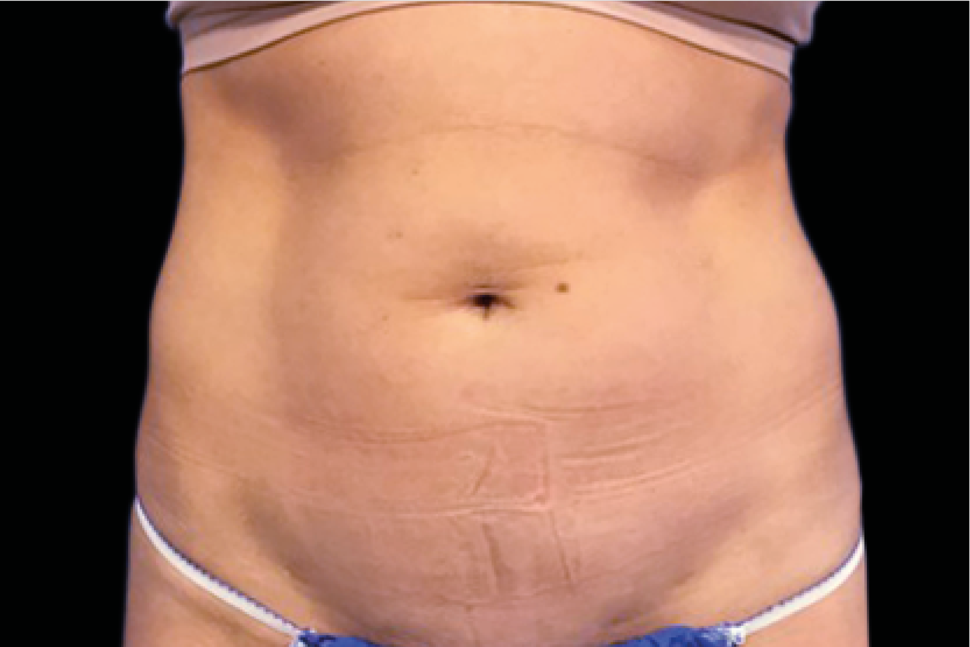 female abdomen - before non invasive cosmetic surgery - Birmingham Dermatology Clinic & Medical Spa | Cahaba Dermatology