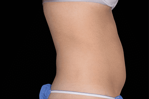 female abdomen - after non invasive cosmetic surgery - Birmingham Dermatology Clinic & Medical Spa | Cahaba Dermatology