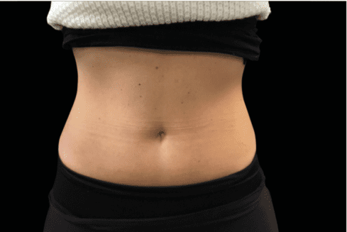 female abdomen - non invasive cosmetic surgery - Birmingham Dermatology Clinic & Medical Spa | Cahaba Dermatology