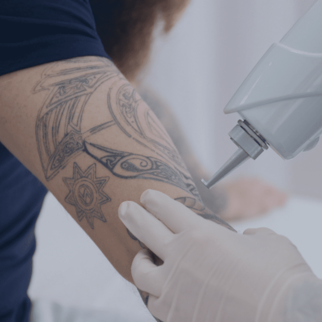 Racist tattoo removal a chance for change  Waatea News Māori Radio Station