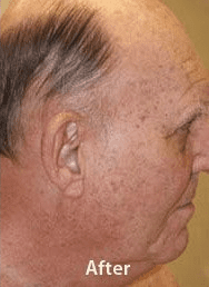 after benign lesions - Skin Care Clinic - Birmingham Dermatology Clinic and Medical Spa | Cahaba Dermatology