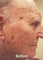 benign lesions - Skin Care Clinic - Birmingham Dermatology Clinic and Medical Spa | Cahaba Dermatology