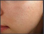 acne treatment after - Birmingham Cosmetic Dermatologist - Medical Spa | Cahaba Dermatology