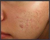 acne treatment before - Birmingham Cosmetic Dermatologist - Medical Spa | Cahaba Dermatology