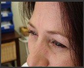after botox - Birmingham Cosmetic Dermatologist - Medical Spa | Cahaba Dermatology