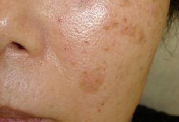 age spots - Birmingham Cosmetic Dermatologist - Medical Spa | Cahaba Dermatology