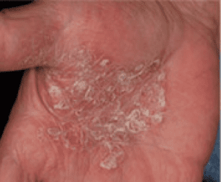 laser skin before - Birmingham Cosmetic Dermatologist - Medical Spa | Cahaba Dermatology