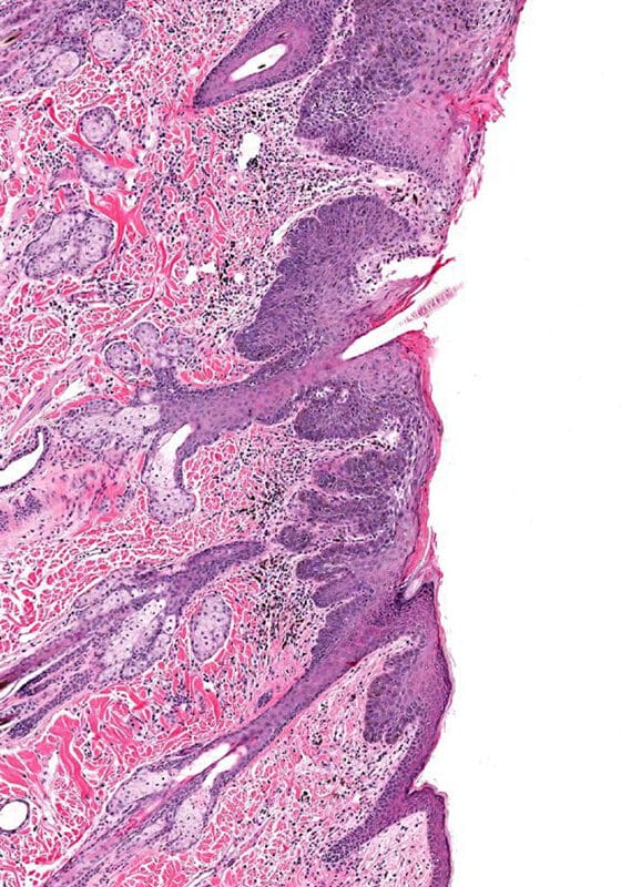 Actinic Keratosis Diagnosis and Treatment at Cahaba Dermatology