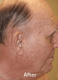 Benign Lesions After Treatment Photo