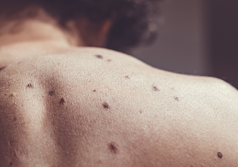 Benign Lesions treated at Cahaba Dermatology in Birmingham