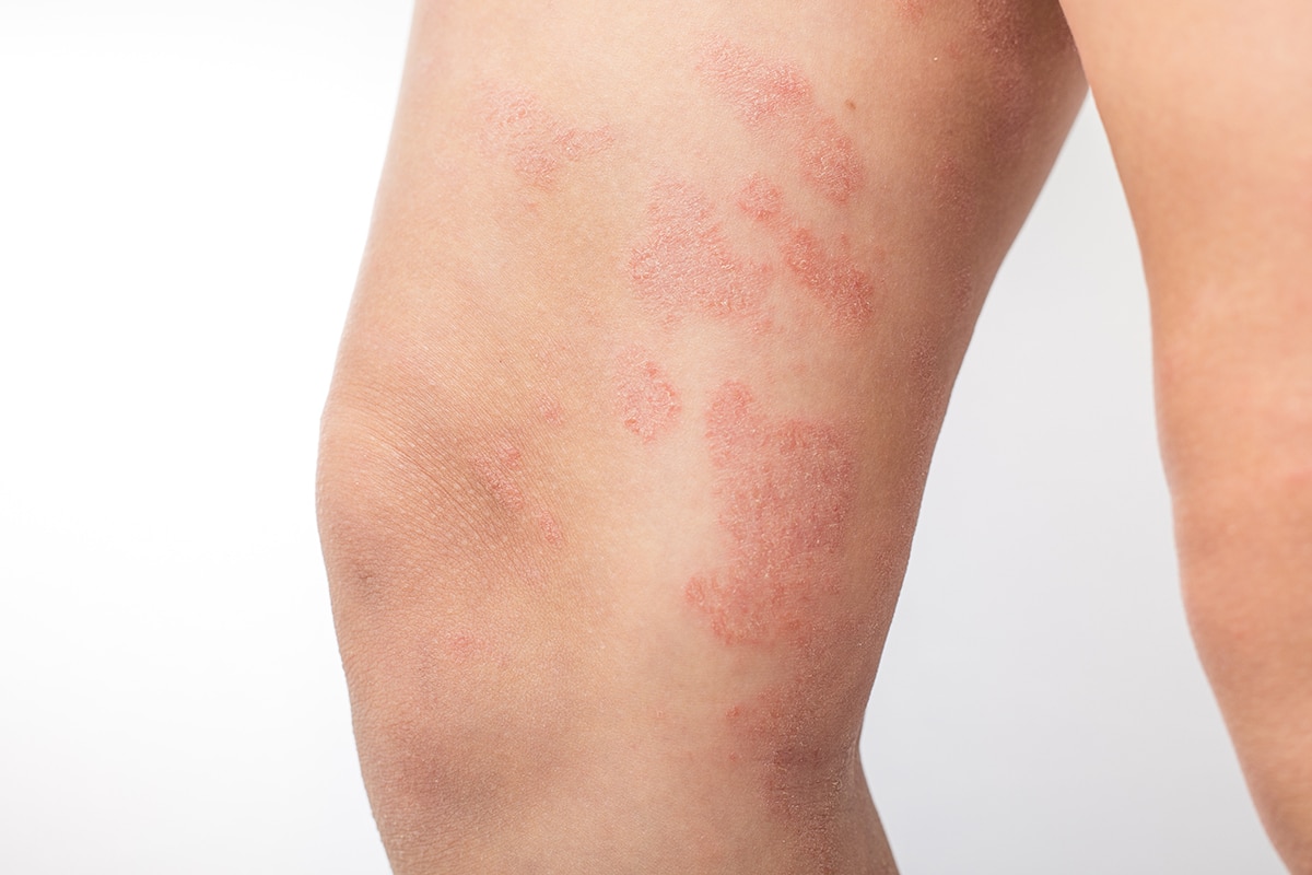 Eczema Treatment at Cahaba Dermatology