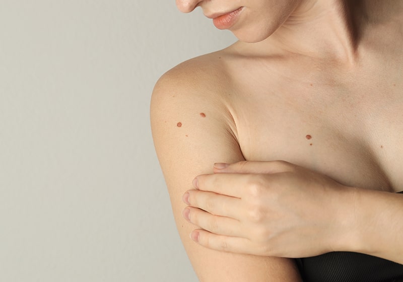 Mole Evaluation & Removal at Cahaba Dermatology
