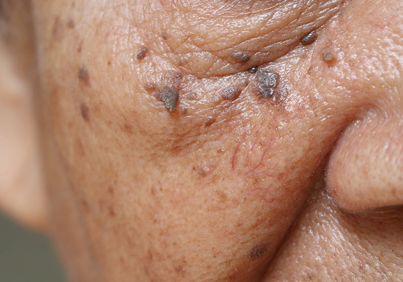 Benign Lesions treated at Cahaba Dermatology in Tuscaloosa