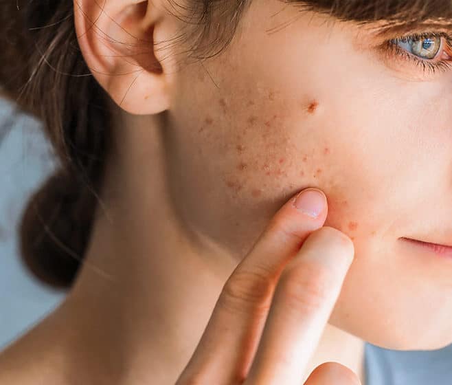 Acne Scar Treatment at Cahaba Dermatology