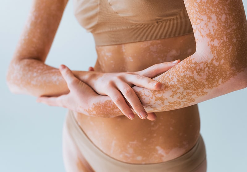 UVB Phototherapy Treatment at Cahaba Dermatology