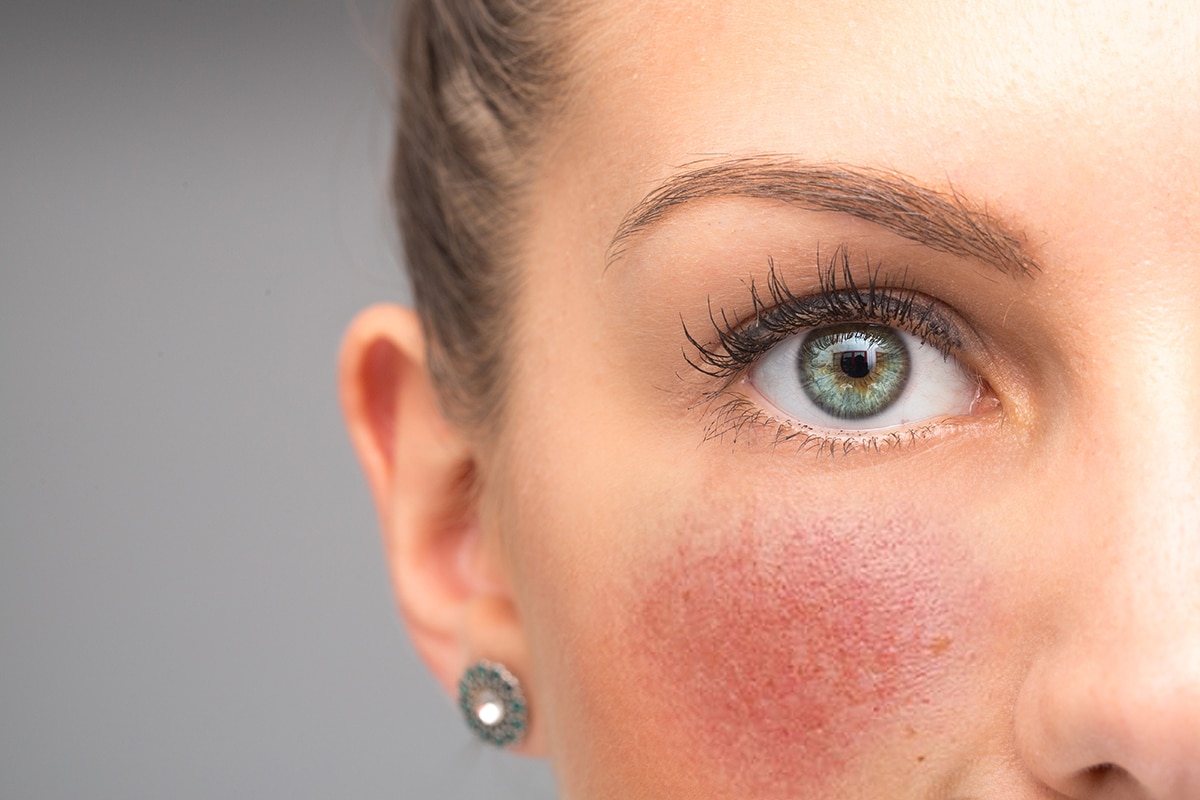 Rosacea Diagnosis and Treatment at Cahaba Dermatology