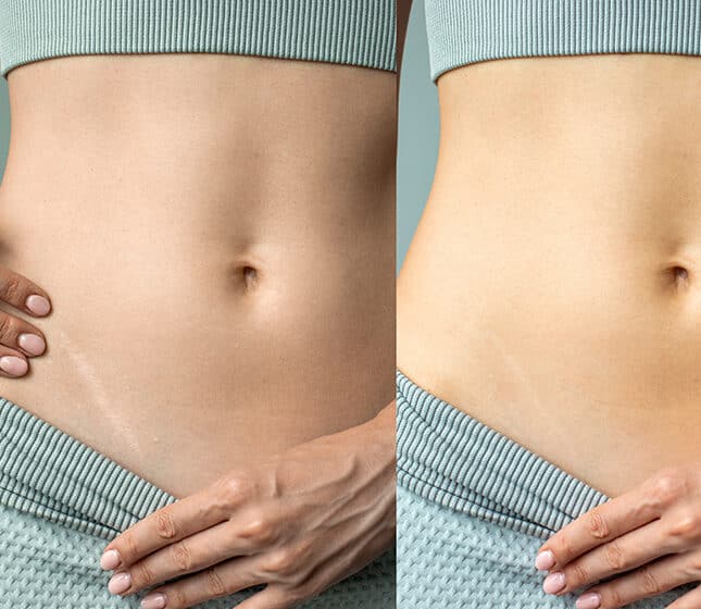 Scar Revision at Cahaba Dermatology