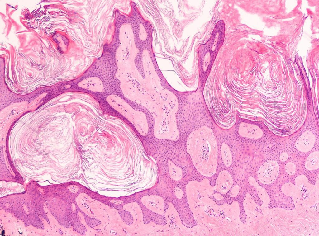 Seborrheic Keratosis treatment at Cahaba Dermatology