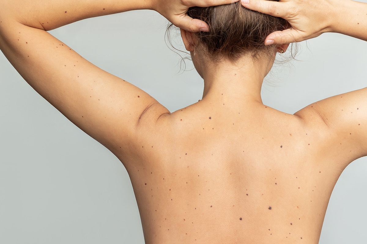 Surgical Dermatology by Cahaba Dermatology in Birmingham, Vestavia Hills and Tuscaloosa, AL