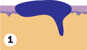 Mohs surgery performed by Cahaba Dermatology