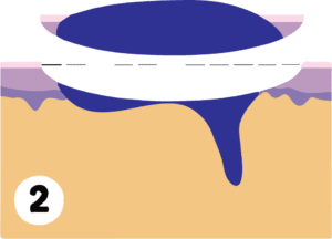 Mohs surgery performed by Cahaba Dermatology