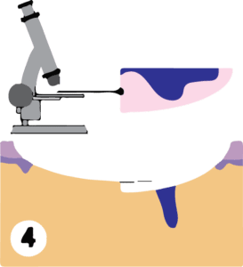 Mohs surgery performed by Cahaba Dermatology