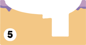 Mohs surgery performed by Cahaba Dermatology